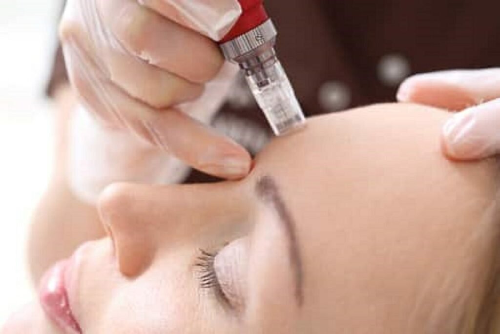 microneedling